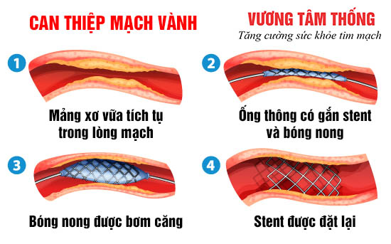 Chỉ định can thiệp mạch vành được áp dụng trong điều trị xơ vữa động mạch.jpg